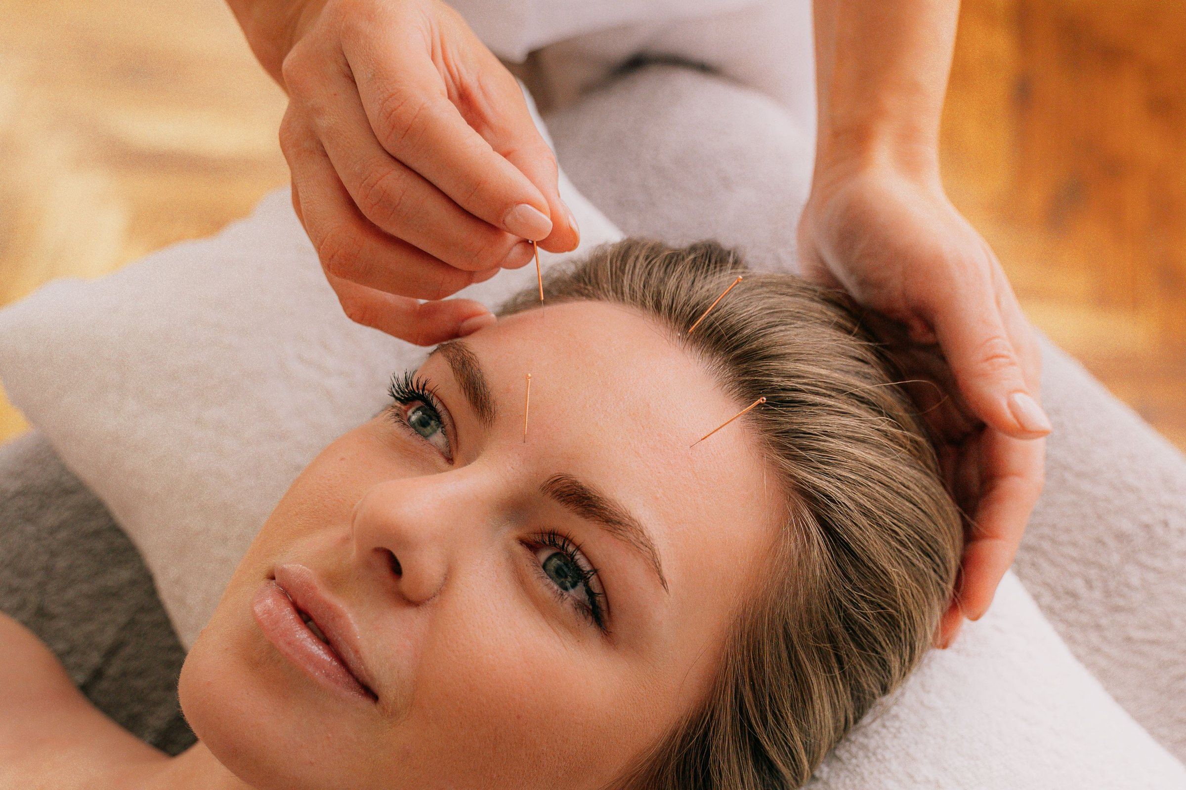 Several acupuncture needles placed across the forehead during a facial treatment